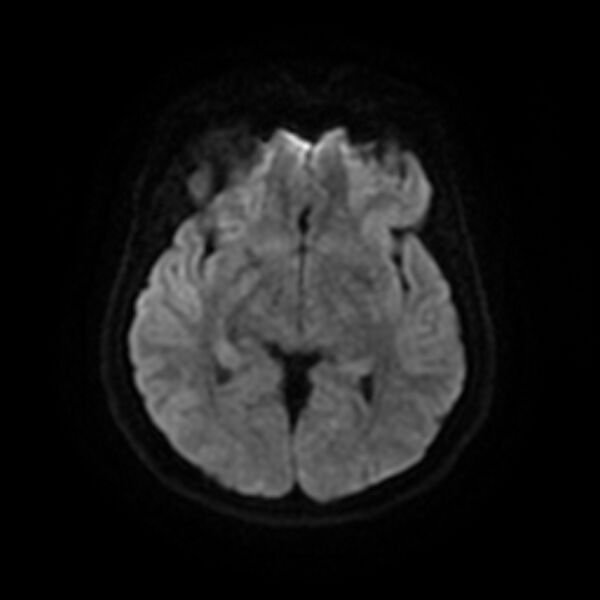 File:Cerebral fat embolism (Radiopaedia 37510-39363 Axial DWI 13).jpg