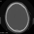 Cerebral hemorrhagic contusion with subdural and subarachnoid hemorrhage (Radiopaedia 10680-11146 Axial bone window 18).jpg
