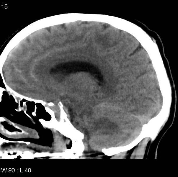 File:Cerebral hemorrhagic contusion with subdural and subarachnoid hemorrhage (Radiopaedia 10680-11146 C 8).jpg