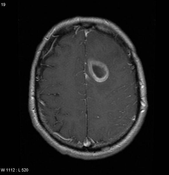 File:Cerebral metastases - renal cell carcinoma (Radiopaedia 5510-7246 Axial T1 C+ 2).jpg