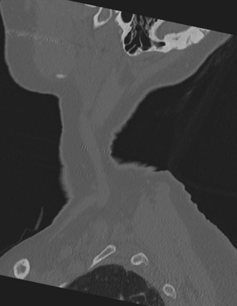 File:Cervical spine ACDF loosening (Radiopaedia 48998-54071 Sagittal bone window 9).png