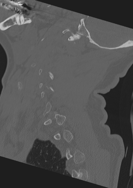 File:Cervical spine fractures with vertebral artery dissection (Radiopaedia 53296-59268 Sagittal bone window 15).png