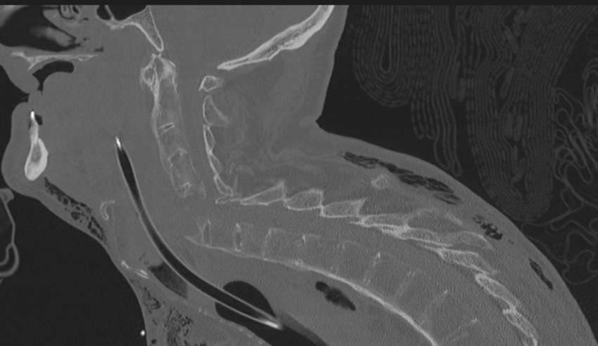 Chalk stick fracture (Radiopaedia 57948-64928 Sagittal bone window 34).png