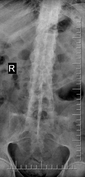File:Chalk stick fracture - ankylosing spondylitis (Radiopaedia 52572-58512 B 1).png
