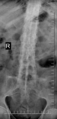 Chalk stick fracture - ankylosing spondylitis (Radiopaedia 52572-58512 B 1).png
