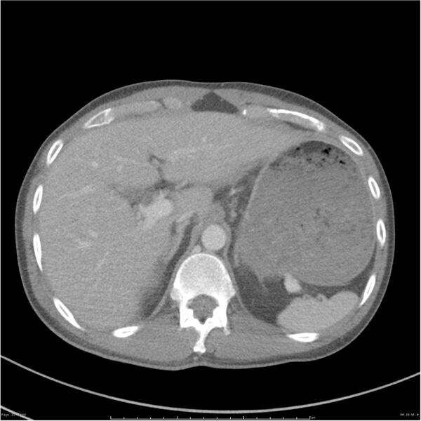 File:Chest and abdomen multi-trauma (Radiopaedia 26294-26426 bone window 22).jpg