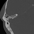 Cholesteatoma (Radiopaedia 15846-15494 bone window 2).jpg