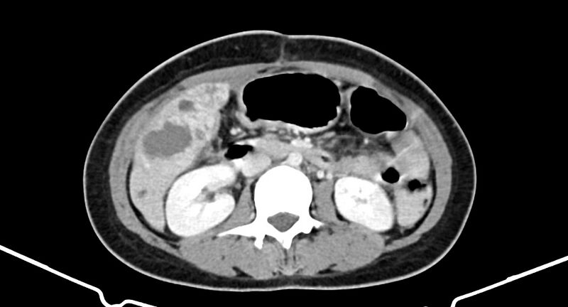File:Choriocarcinoma liver metastases (Radiopaedia 74768-85766 A 103).jpg