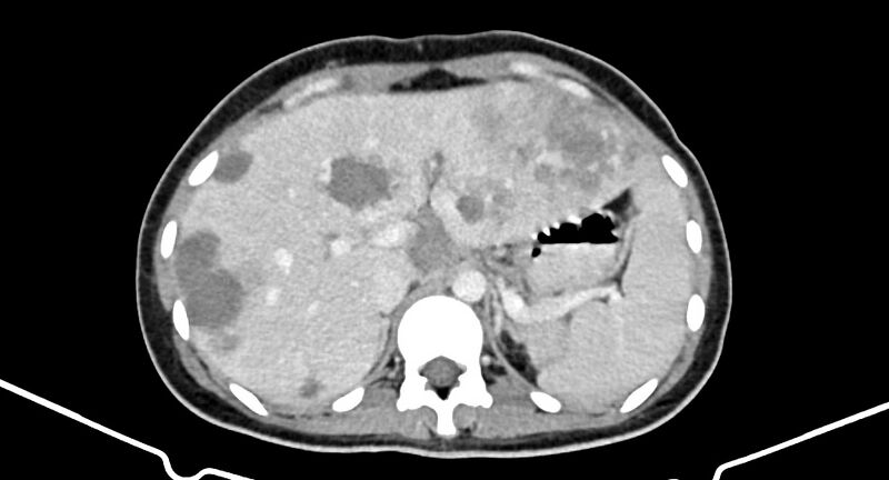 File:Choriocarcinoma liver metastases (Radiopaedia 74768-85766 A 62).jpg