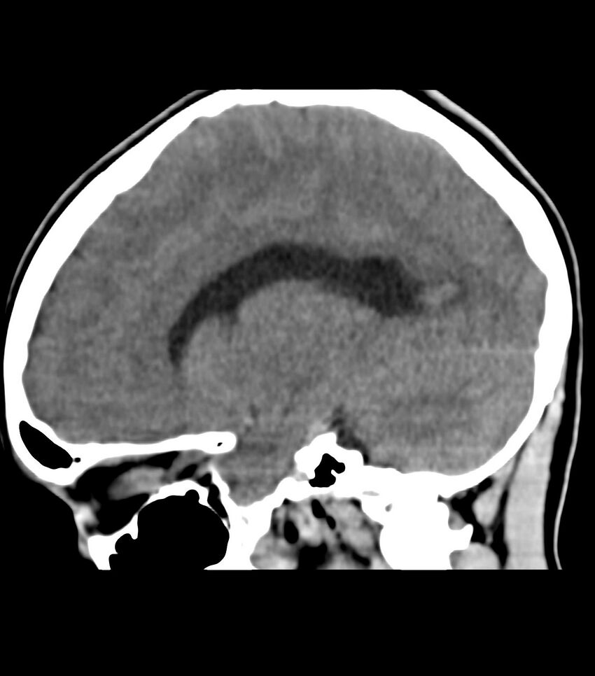 Choroid plexus carcinoma (Radiopaedia 91013-108552 B 29).jpg