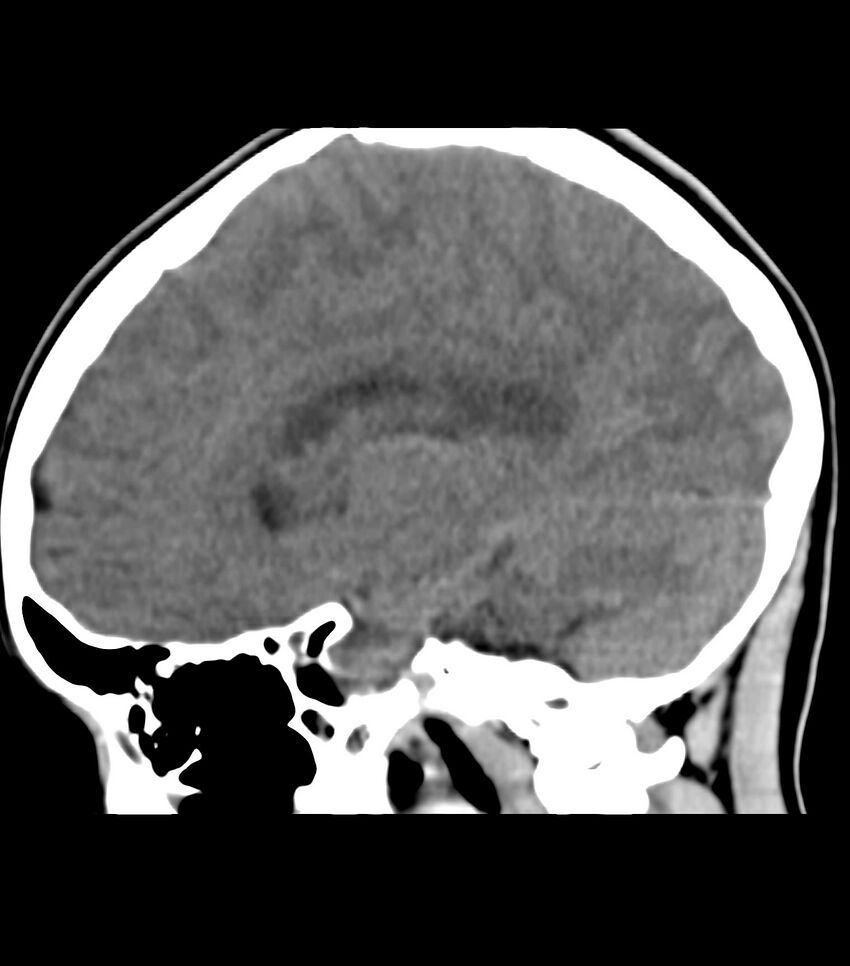 Choroid plexus carcinoma (Radiopaedia 91013-108552 B 31).jpg