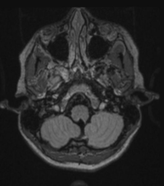 File:Choroid plexus carcinoma (Radiopaedia 91013-108553 Axial FLAIR C+ 83).jpg