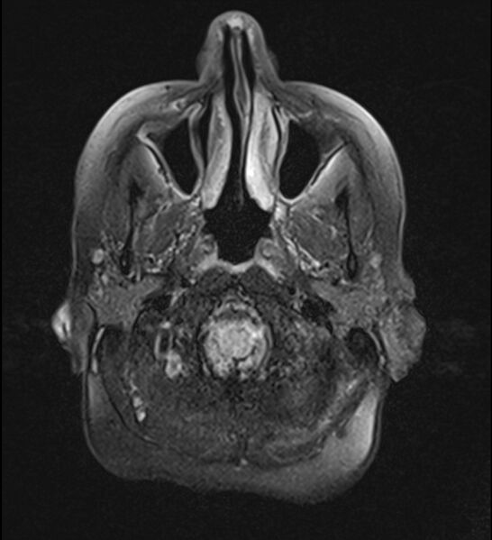 File:Choroid plexus xanthogranuloma (Radiopaedia 91271-108875 Axial T2 TIRM 3).jpg