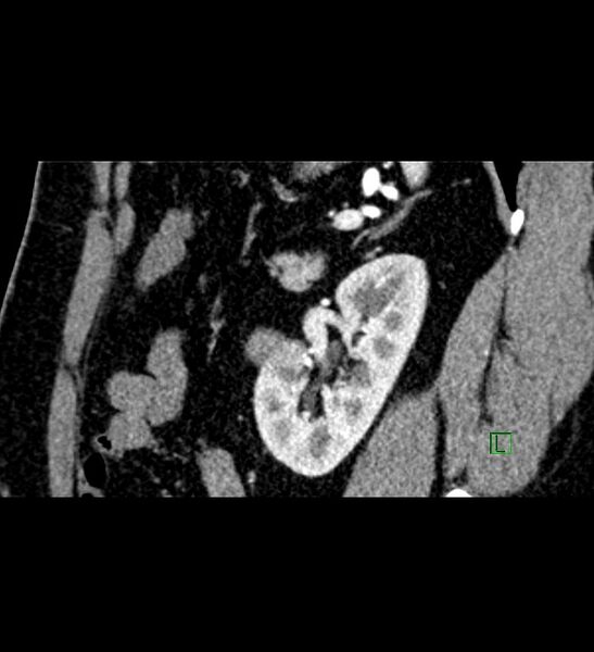 File:Chromophobe renal cell carcinoma (Radiopaedia 84286-99573 F 48).jpg