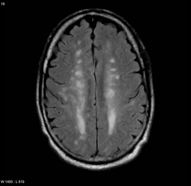 File:Chronic hypertensive encephalopathy (Radiopaedia 4564-6686 Axial FLAIR 12).jpg