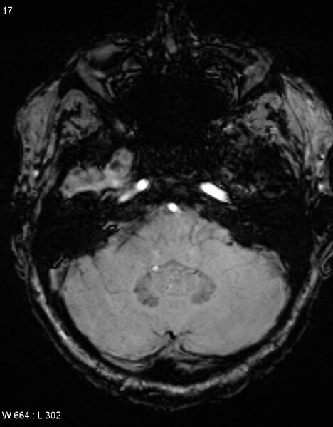 File:Chronic lymphocytic inflammation with pontine perivascular enhancement responsive to steroids (CLIPPERS) (Radiopaedia 37520-39374 Axial SWI 16).jpg
