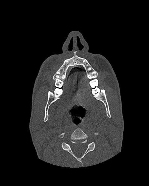 File:Chronic maxillary sinusitis caused by a foreign body (Radiopaedia 58521-65676 Axial bone window 26).jpg