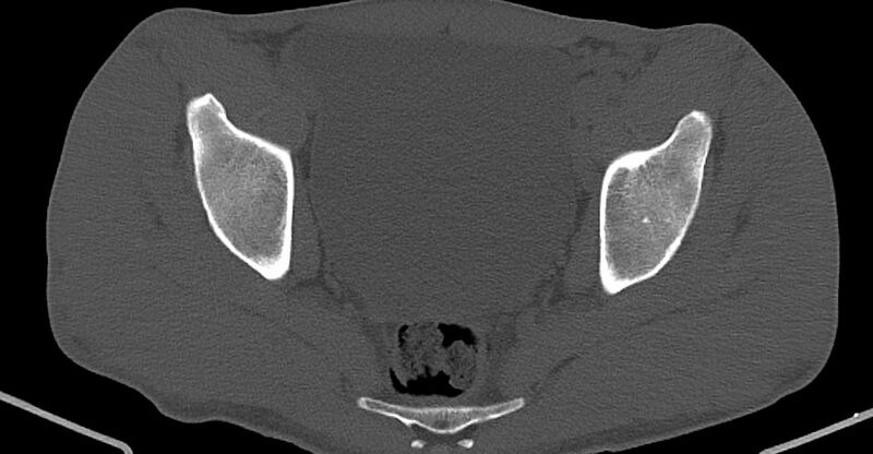 File:Chronic osteomyelitis (with sequestrum) (Radiopaedia 74813-85822 Axial non-contrast 27).jpg