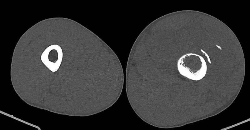 File:Chronic osteomyelitis (with sequestrum) (Radiopaedia 74813-85822 Axial non-contrast 94).jpg