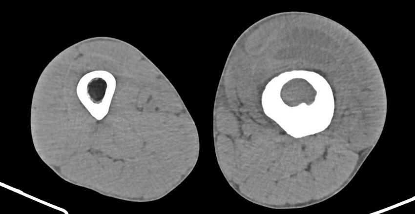 Chronic osteomyelitis (with sequestrum) (Radiopaedia 74813-85822 D 116).jpg