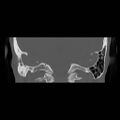 Chronic otomastoiditis (Radiopaedia 27138-27309 Coronal bone window 18).jpg