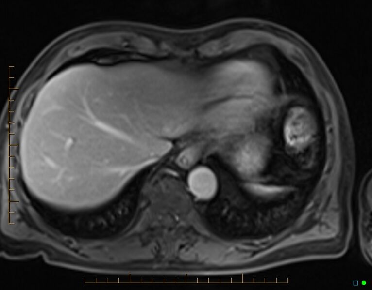 File:Chronic pancreatitis (Radiopaedia 17014-16716 Axial T1 C+ fat sat 3).jpg