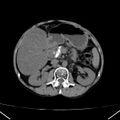 Chronic pancreatitis (Radiopaedia 23132-23172 Axial non-contrast 31).jpg