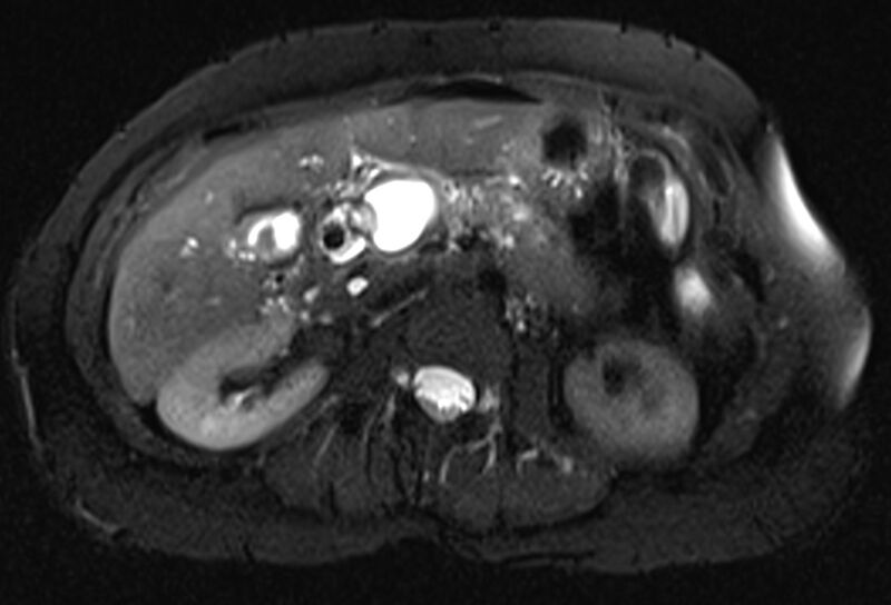 File:Chronic pancreatitis - pancreatic duct calculi (Radiopaedia 71818-82250 Axial T2 fat sat 32).jpg