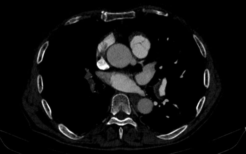 File:Chronic pulmonary embolism (Radiopaedia 91241-108843 B 102).jpg