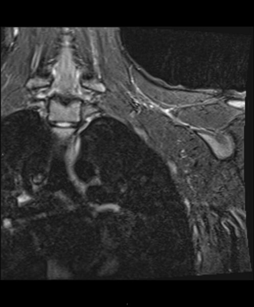 File:Chronic reactive multifocal osteomyelitis (CRMO) - clavicle (Radiopaedia 56406-63114 Coronal STIR 5).jpg