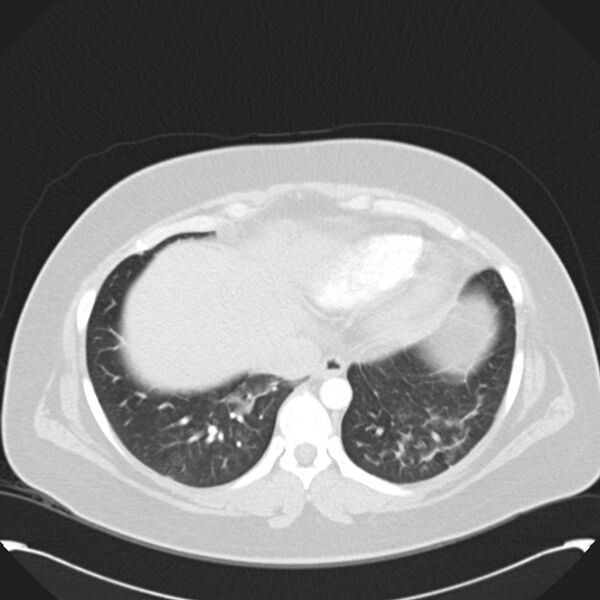 File:Chronic thromboembolic pulmonary hypertension (CTEPH) (Radiopaedia 74597-85531 Axial lung window 40).jpg