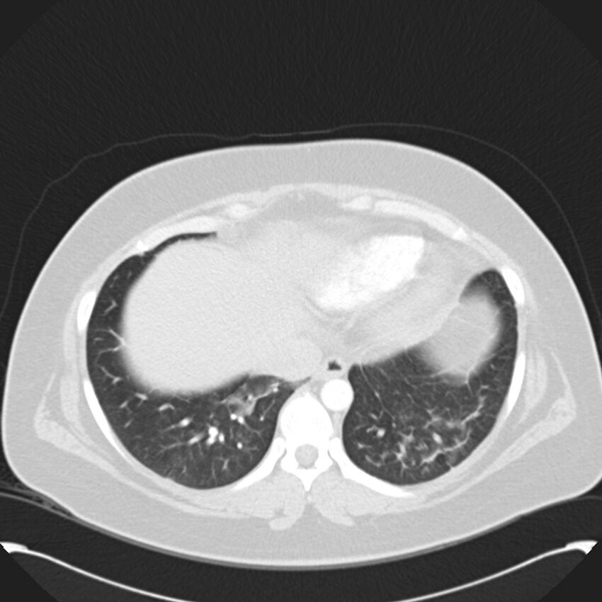 Chronic thromboembolic pulmonary hypertension (CTEPH) (Radiopaedia 74597-85531 Axial lung window 40).jpg