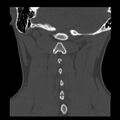 Clay-shoveler fracture (Radiopaedia 22568-22590 Coronal bone window 30).jpg