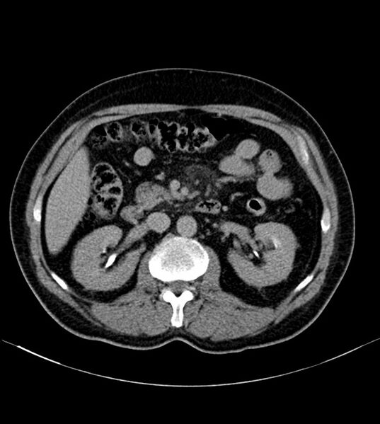 File:Clear cell renal cell carcinoma (Radiopaedia 85006-100539 H 15).jpg