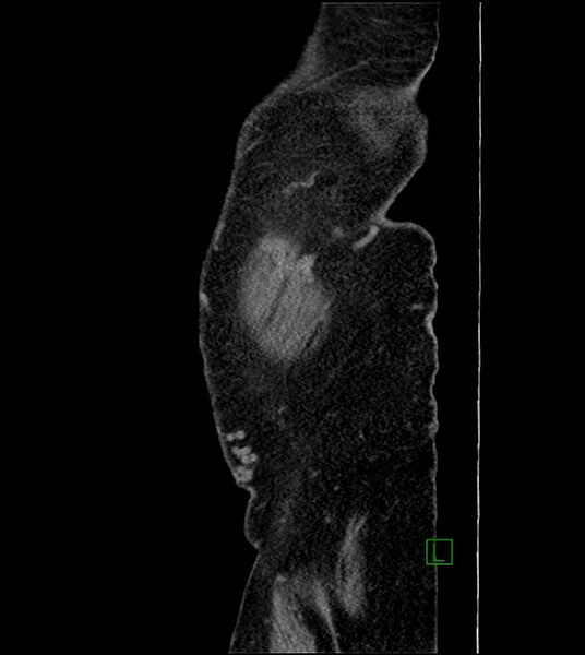 File:Closed-loop small bowel obstruction-internal hernia (Radiopaedia 78439-91096 C 137).jpg