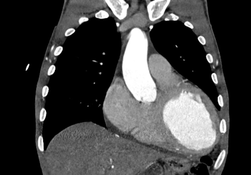 File:Coarctation of aorta with aortic valve stenosis (Radiopaedia 70463-80574 C 67).jpg