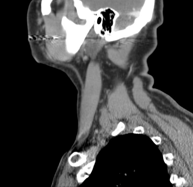 File:Colloid cyst of thyroid (Radiopaedia 22897-22923 Sagittal C+ delayed 14).jpg