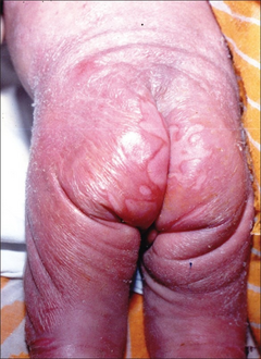 Erosive lesions over natal cleft