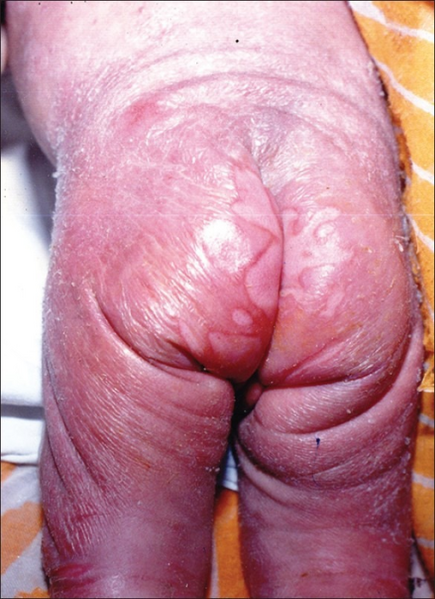 File:Congenital syphilis. Erosive lesions over natal cleft.png