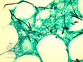 Histopathology (DermNet NZ fungal-aspergillus-01).jpg