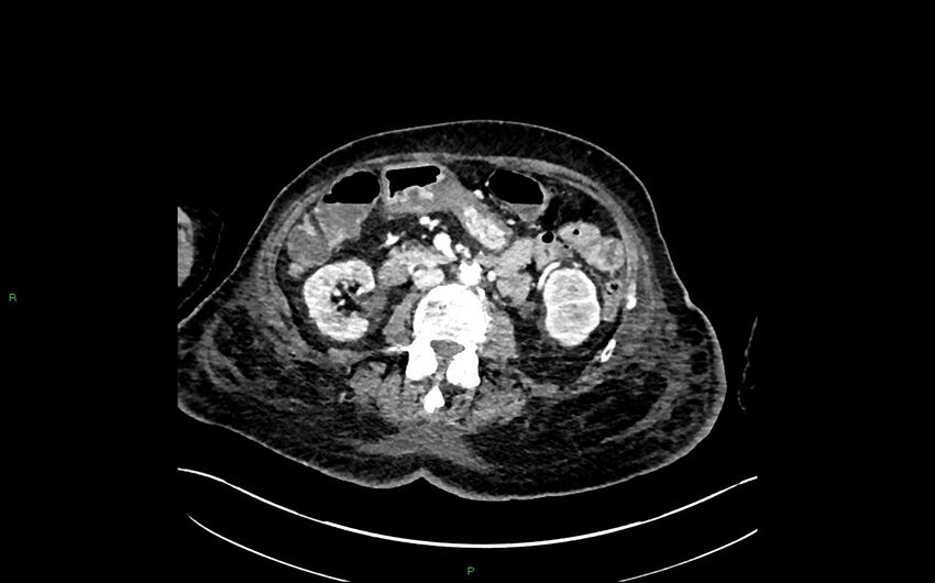 Neo-terminal ileal stricture (Crohn disease) (Radiopaedia 33790-34948 A 197).jpg
