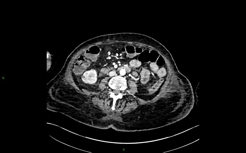 Neo-terminal ileal stricture (Crohn disease) (Radiopaedia 33790-34948 A 220).jpg
