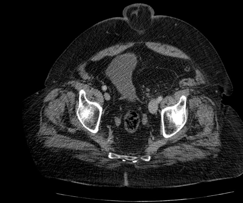 Nephroptosis with inguinal hernia containing perirenal fat (Radiopaedia 56632-63391 C 296).jpg