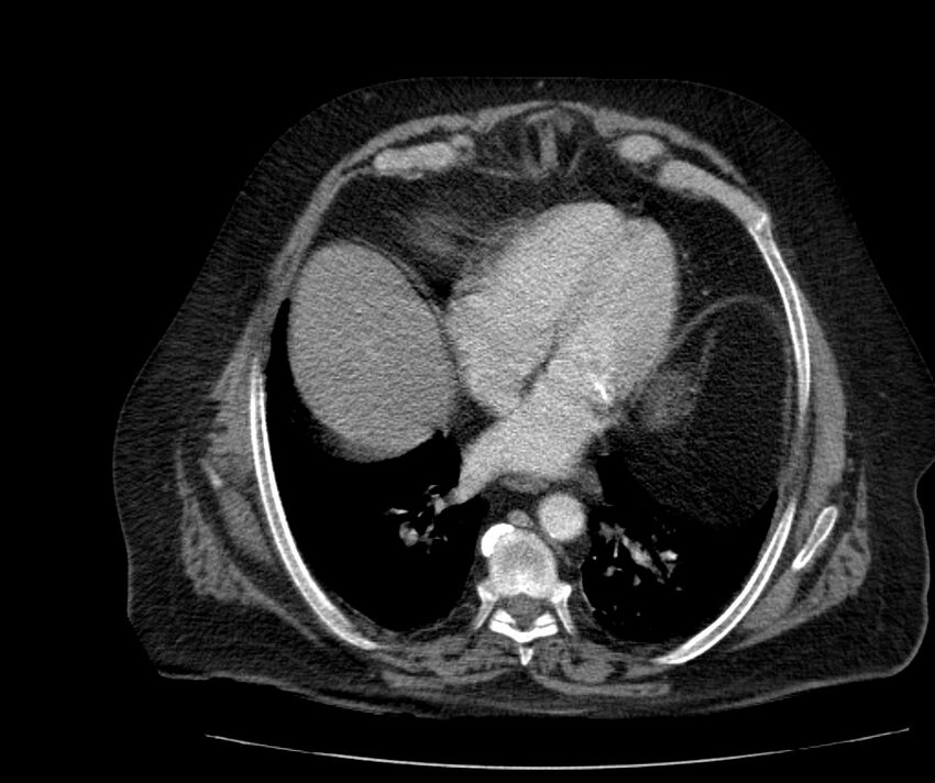 Nephroptosis with inguinal hernia containing perirenal fat (Radiopaedia 56632-63391 C 37).jpg