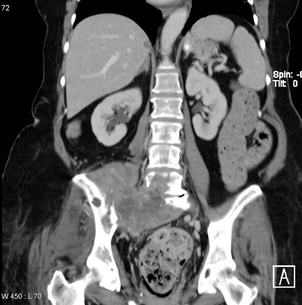 File:Nerve sheath tumor - malignant - sacrum (Radiopaedia 5219-6987 B 8).jpg