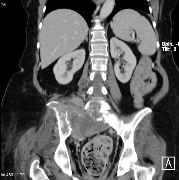 File:Nerve sheath tumor - malignant - sacrum (Radiopaedia 5219-6987 B 9).jpg