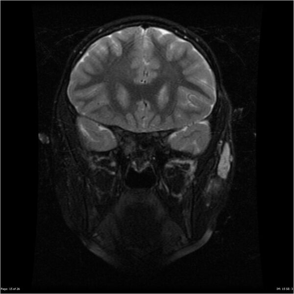 File:Neurofibromatosis type 1 (Radiopaedia 22541-22564 C 15).jpg