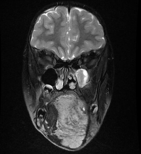 File:Neurofibromatosis type 1 (Radiopaedia 6954-8063 Coronal T2 2).jpg