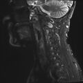 Neurofibromatosis type 1 (Radiopaedia 80355-93740 Sagittal STIR 9).jpg