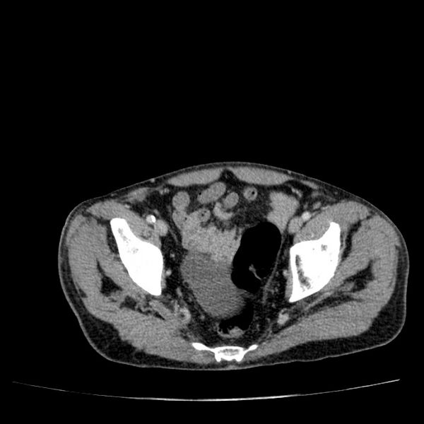 File:Non small-cell lung cancer (Radiopaedia 24467-24769 C+ delayed 108).jpg